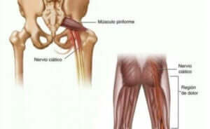 placering af piriformis-muskel